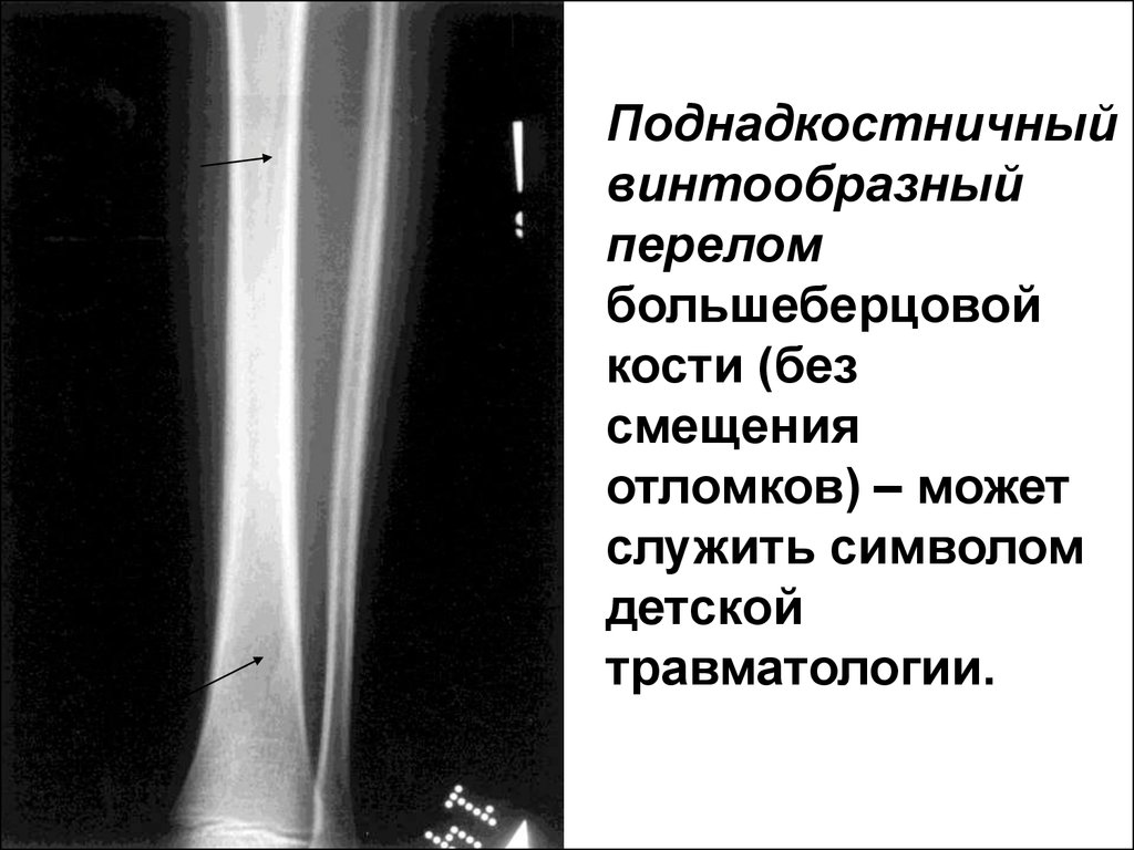 Перелом большеберцовой кости. Винтообразный перелом большеберцовой. Винтообразный перелом смещение отломков. Перелом в2 большеберцовой кости. Винтообразный перелом большеберцовой кости.