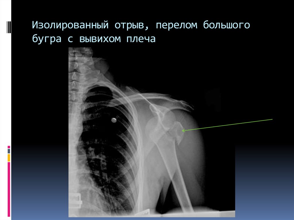 Рентген вывиха плеча фото