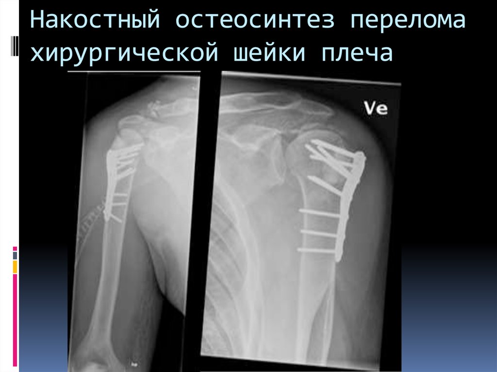 Перелом плеча. Перелом хирургической шейки плечевой кости рентген остеосинтез. Перелом хирургической шейки плечевой кости остеосинтез. Остеосинтез при переломе шейки плечевой кости. Остеосинтез пластиной перелома хирургической шейки плечевой кости.