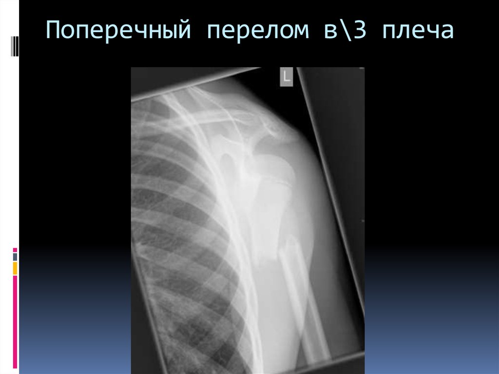 Поперечный перелом. Поперечный перелом плечевой кости. Поперечный перелом диафиза. Поперечный перелом рентген.