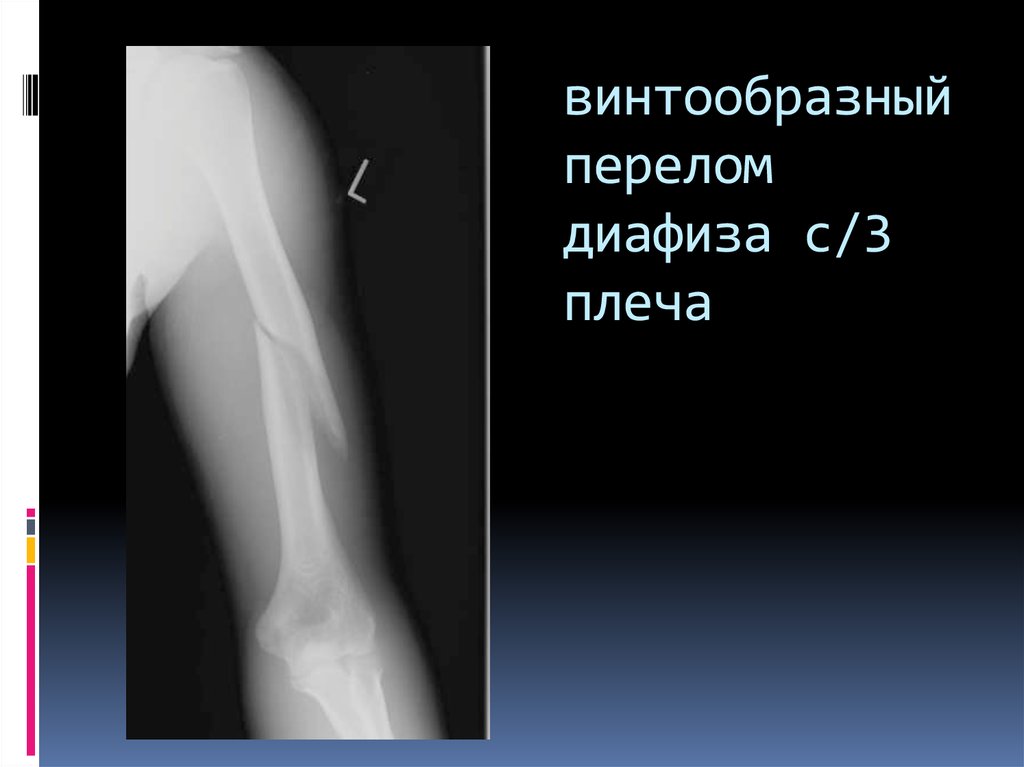 Перелом плеча со смещением. Перелом средней трети диафиза плечевой кости. Спиральный перелом плечевой кости. Винтообразный перелом диафиза плеча. Перелом диафиза плечевой кости рентген.