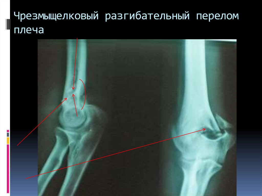 Переломы плечевой кости презентация