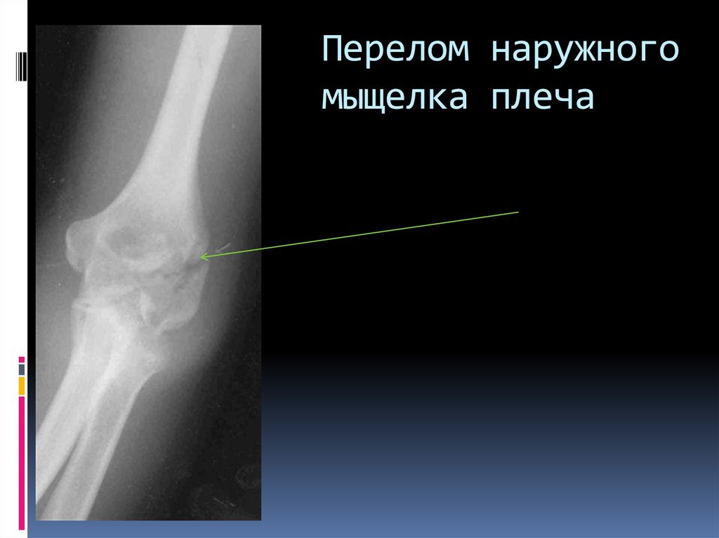 Трещина наружной. Перелом наружного мыщелка плечевой кости. Перелом мыщелка плечевой кости рентген. Наружный мыщелок плечевой кости рентген. Перелом головки мыщелка плечевой кости со смещением.