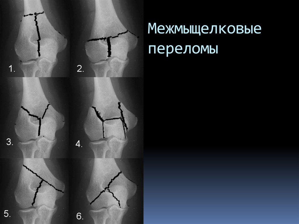 Межмыщелковое возвышение большеберцовой кости. Т образный перелом мыщелков бедра. Перелом мыщелка плечевой кости рентген. Перелом мыщелков бедренной кости рентген. Межмыщелковый перелом плечевой кости.