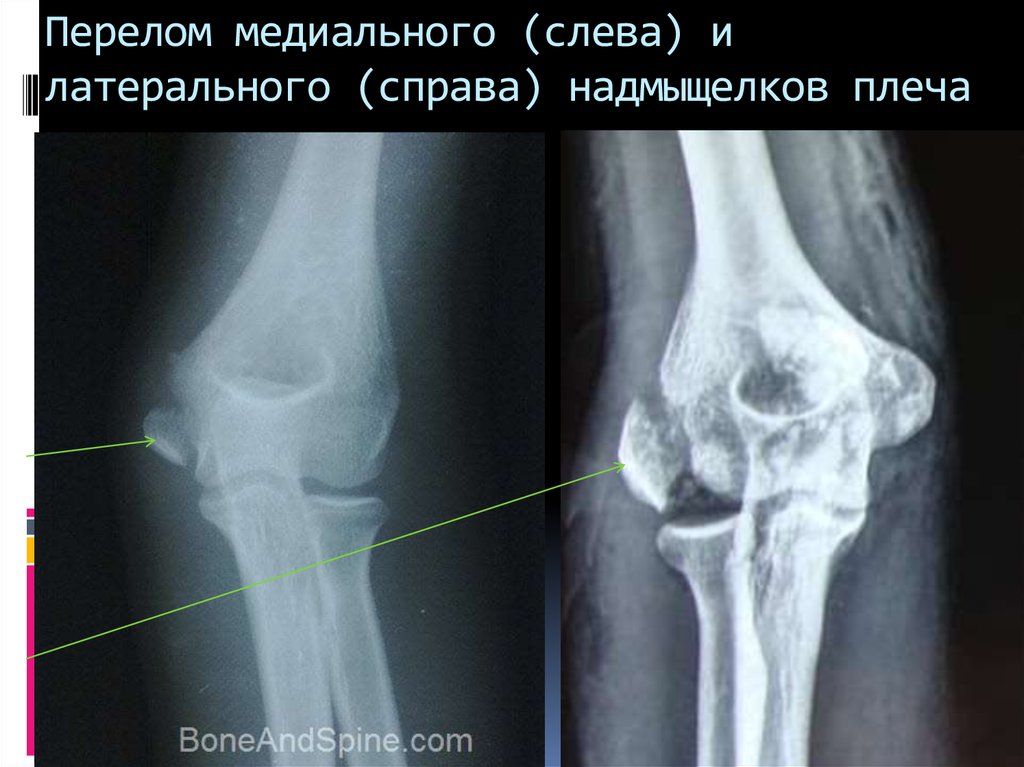 Медиальному надмыщелку кости