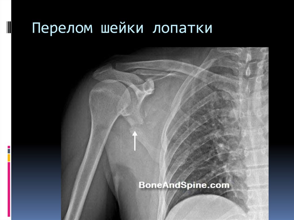 Перелом шейки бедра локальный статус карта смп