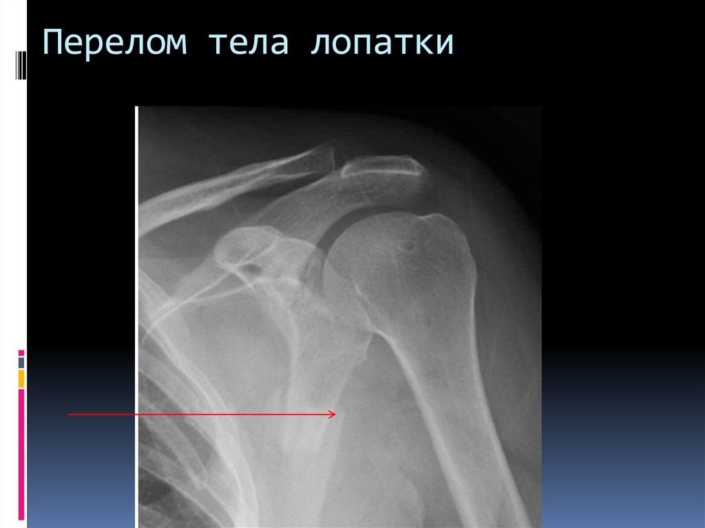 Разрыв лопатки. Перелом шейки плечевой кости рентген. Шейка плечевой кости рентген. Перелом угла лопатки рентген. Перелом акромиона лопатки рентген.