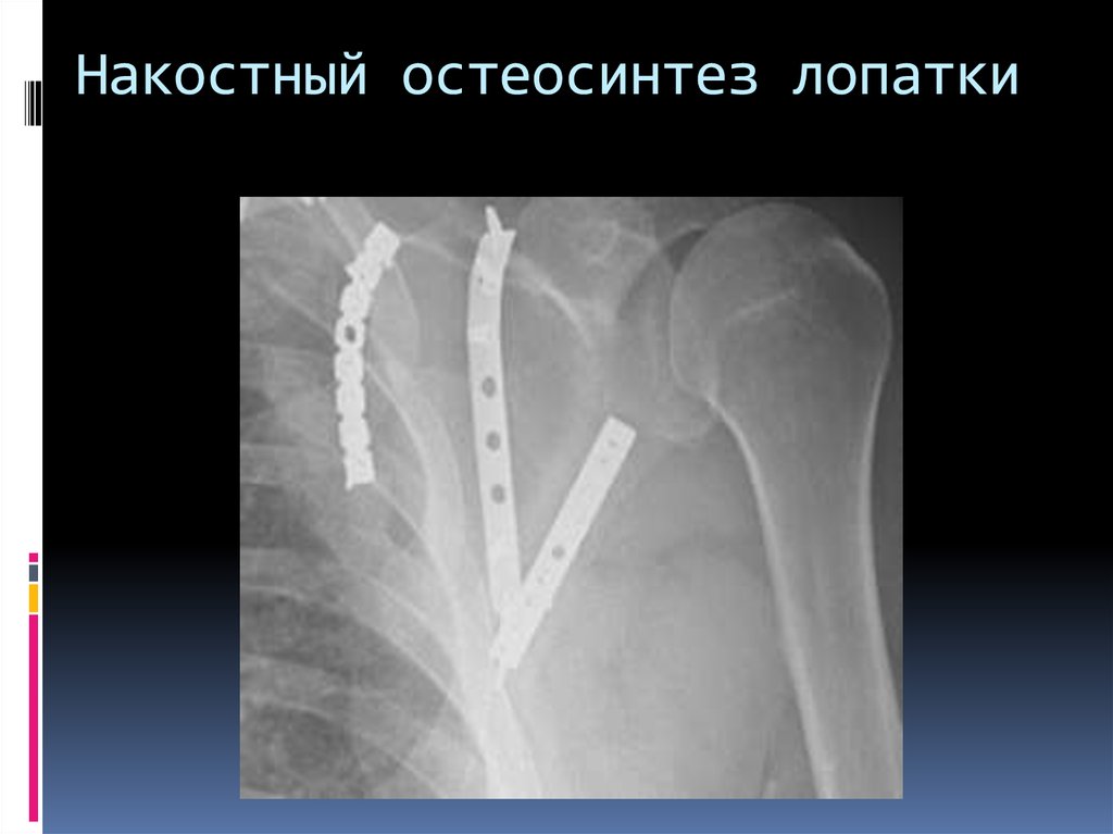 Перелом лопатки. Остеосинтез перелома лопатки. Перелом плечевой лопатки рентген. Перелом шейки лопатки рентген. Накостный остеосинтез рентгенограмма.