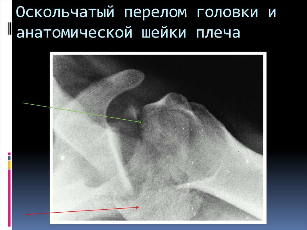 Оскольчатый перелом кости