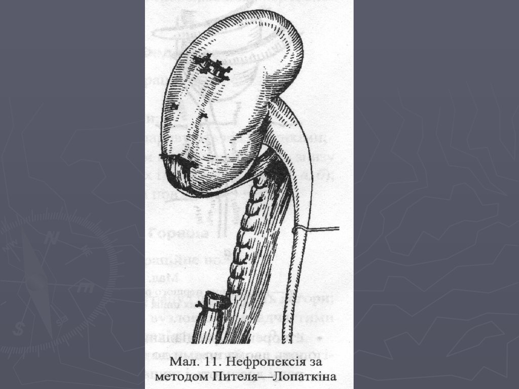 Нефропексия это. Нефроптоз классификация по степеням. Нефропексия мышечным лоскутом. Операция по нефроптозу. Нефроптоз урология презентация.