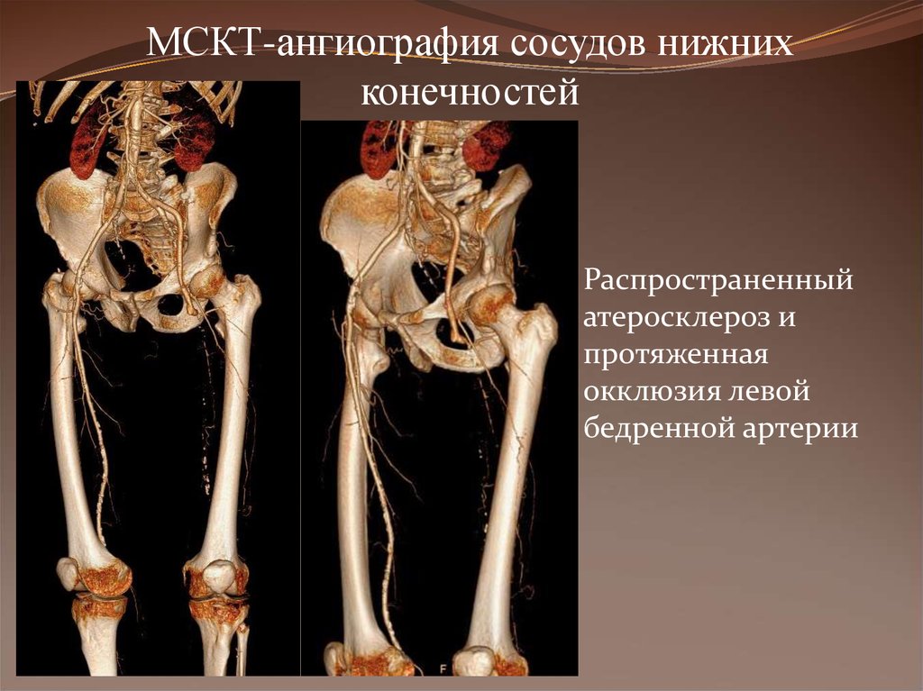 Окклюзия бедренной. МСКТ ангиография сосудов нижних конечностей. Кт ангиография сосудов нижних конечностей. Кт ангиография сосудов нижних конечностей с контрастированием. Кт ангиография конечности.