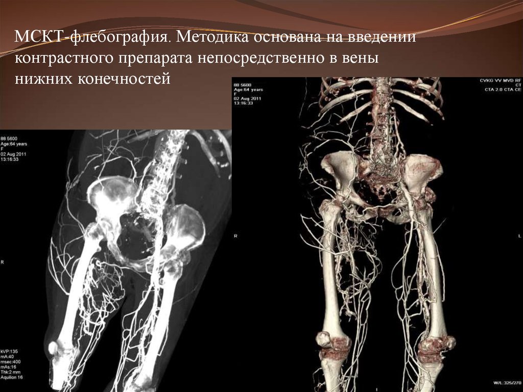 Кт ангиография нижних конечностей