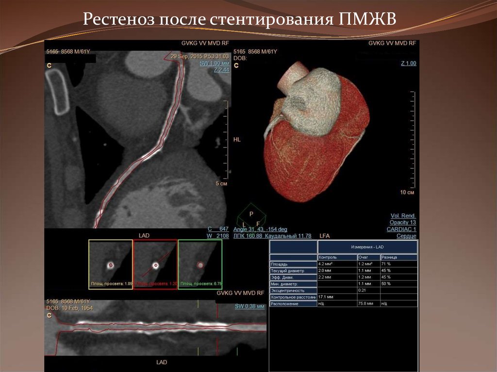 Узи коронарных артерий. Рестеноз коронарных артерий после стентирования. Стентирование коронарных артерий кт. Что такое рестеноз после стентирования. Стентирование передней межжелудочковой артерии.