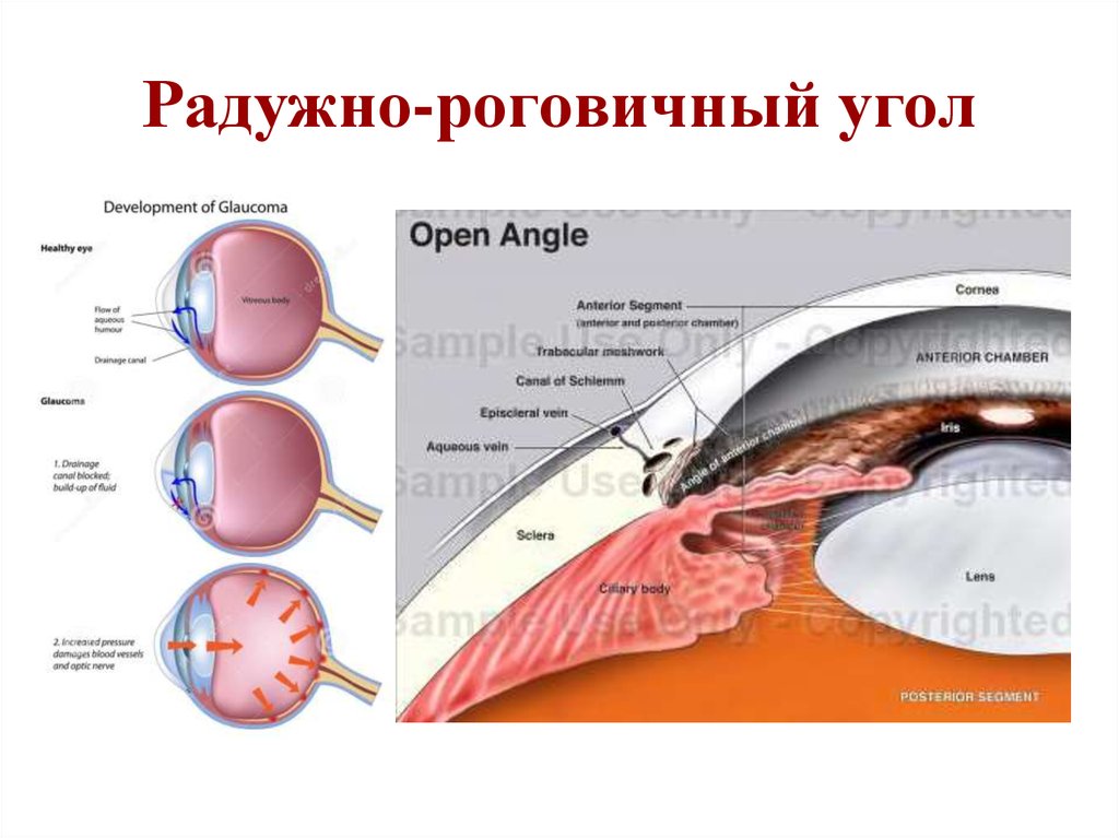 Роговичная дуга фото