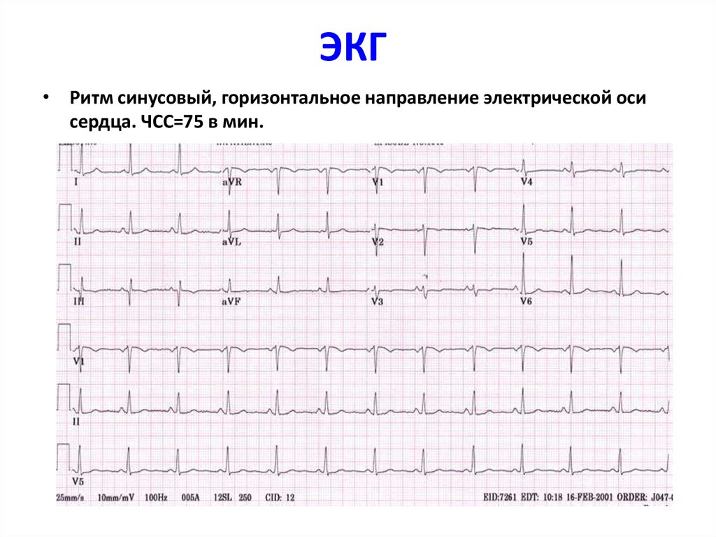 Что значит синусовый ритм сердца на экг. ЭКГ ритм синусовый с ЧСС 77. ЭКГ ритм синусовый отклонение ЭОС. ЭКГ нормальный синусовый ритм. (ЭКГ) ритм синусовый с ЧСС 72 В.