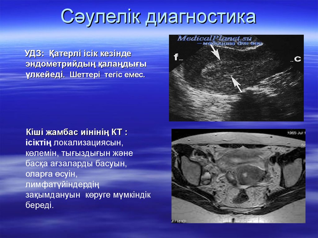 Предраковый эндометрий. УЗИ метод лучевой диагностики. Исследование тела матки. Злокачественное новообразование эндометрия. Лучевая диагностика органов малого таза.