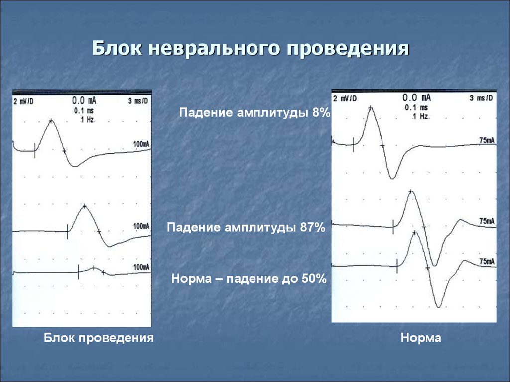 25 20 амплитуда. Блок проведения ЭНМГ. М ответ при ЭНМГ. Блоки проведения на ЭНМГ степени. М-ответ на ЭМГ.