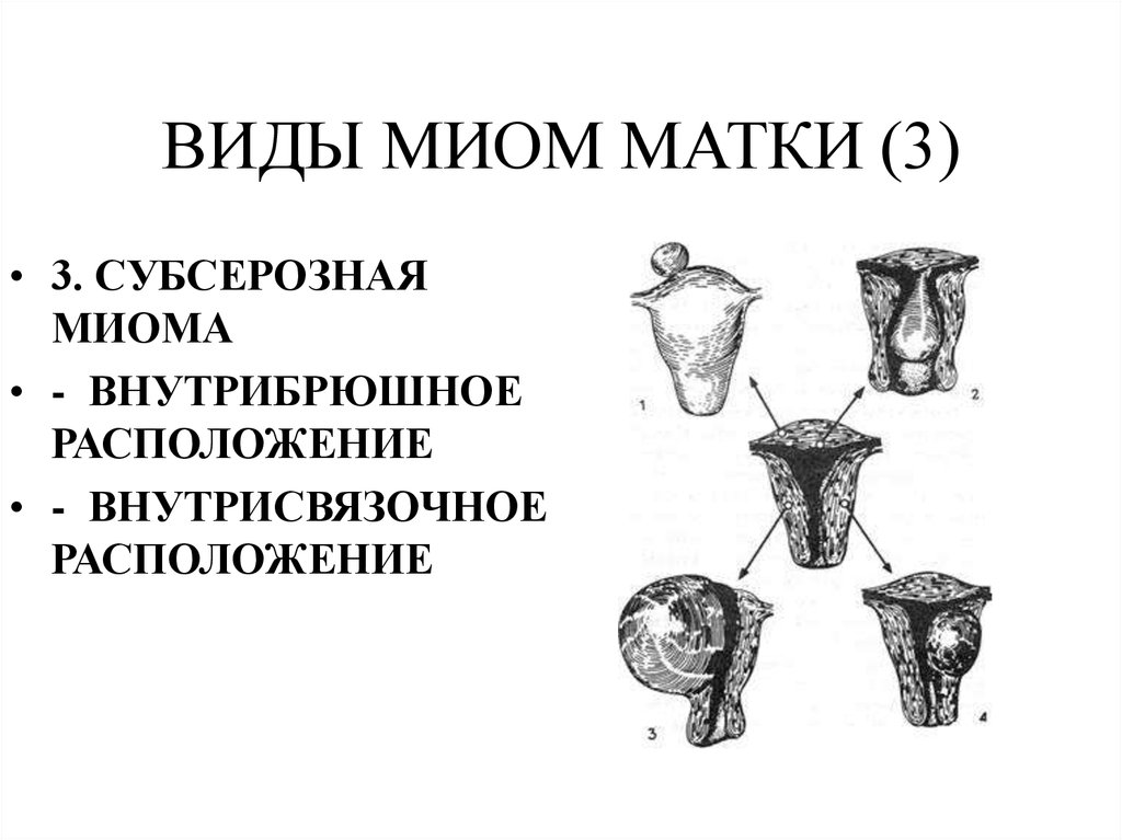 Миома на фоне приема кок