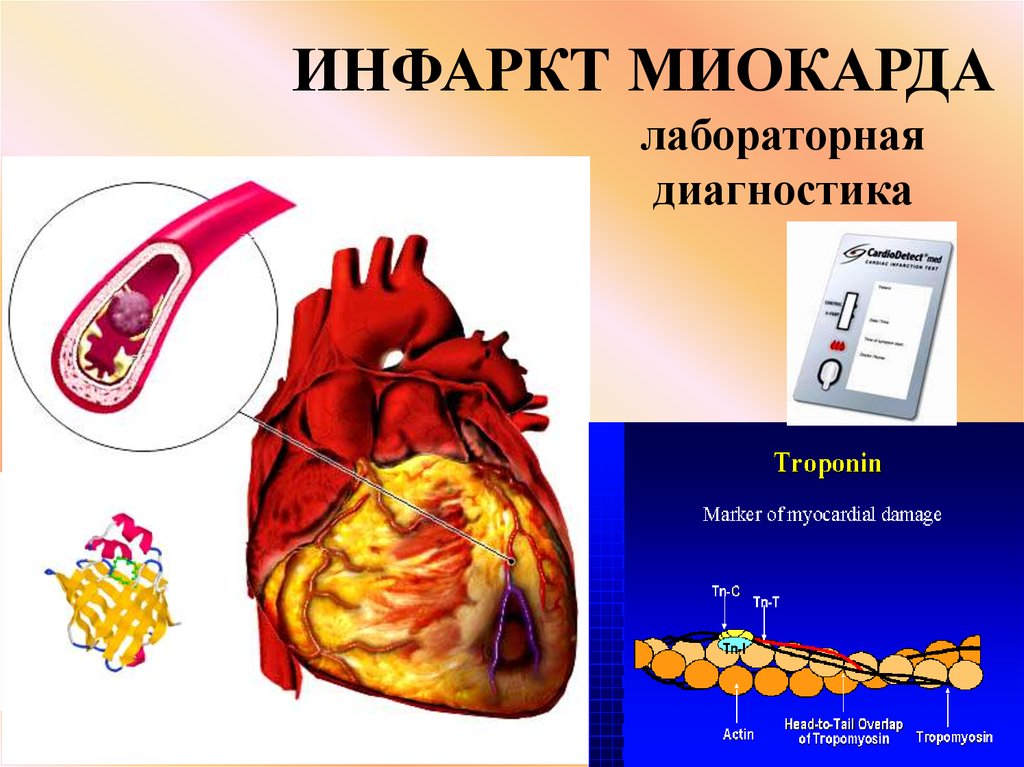 Профилактика инфаркта миокарда картинки