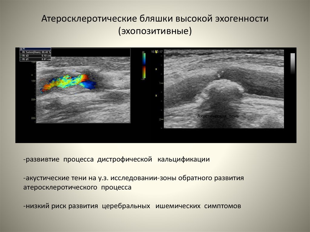Эхографические признаки атеросклеротического. Типы атеросклеротических бляшек УЗИ. Атеросклеротическая бляшка УЗИ. Акустическая тень на УЗИ. Гипоэхогенная бляшка.