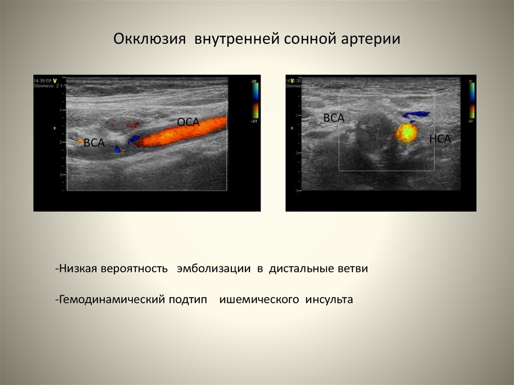 Внутренняя окклюзия. Окклюзия сонной артерии на УЗИ. Окклюзия наружной сонной артерии на УЗИ. Окклюзия ВСА сонной артерии. Окклюзия внутренней сонной артерии на УЗИ.