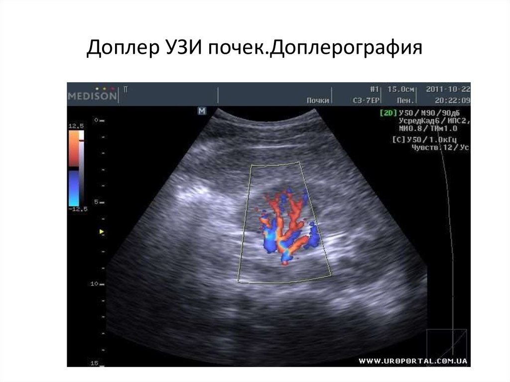 Узи почек и надпочечников. УЗИ сосудов почки допплер. Доплерографическое исследование сосудов почек. Доплеровские УЗИ эхограммы. УЗИ почек с доплером.