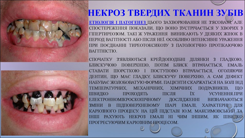Некроз твердих тканин зубів