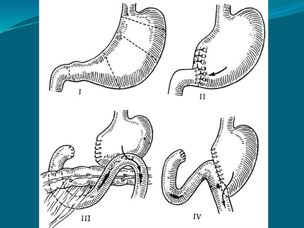 Операция желудка кишечника. Гастрэктомия Бильрот 2. Схема резекции желудка по Бильрот 1.