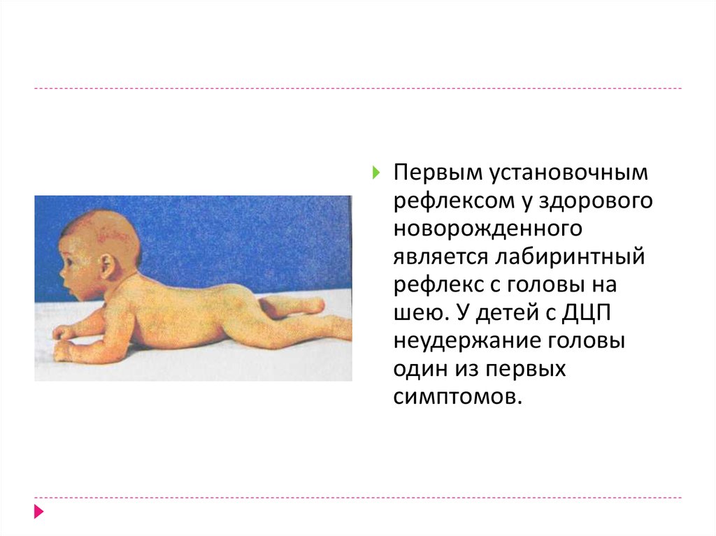 Дцп у грудничка. Асимметричный шейный тонический рефлекс. Первые симптомы ДЦП У грудничка. Младенец с ДЦП У новорожденного.