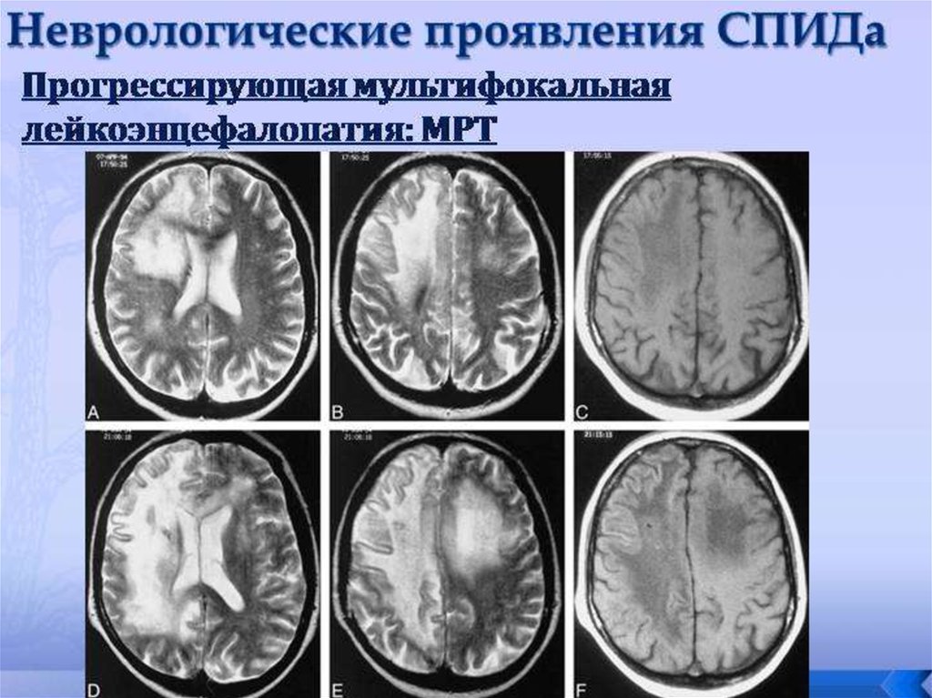 Мр картина перивентрикулярной лейкопатии