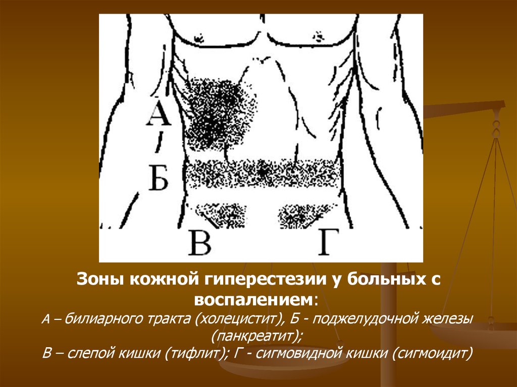 Зона кожи. Зоны кожной гиперестезии. Зоны гиперестезии кожи что это. Зоны гиперестезии живота. Зоны гиперестезии при пальпации.