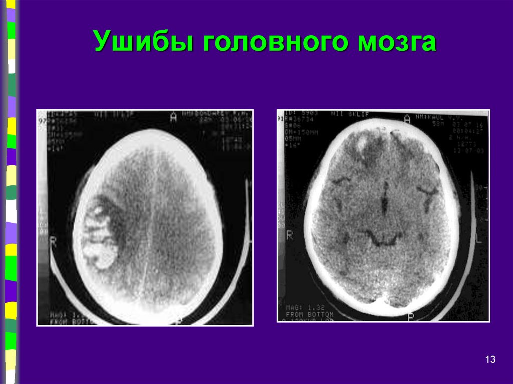 Небольшое сотрясение. Локализация ушиба головного мозга. Ушиб головного мозга легкой степени. Закрытые травмы головного мозга.