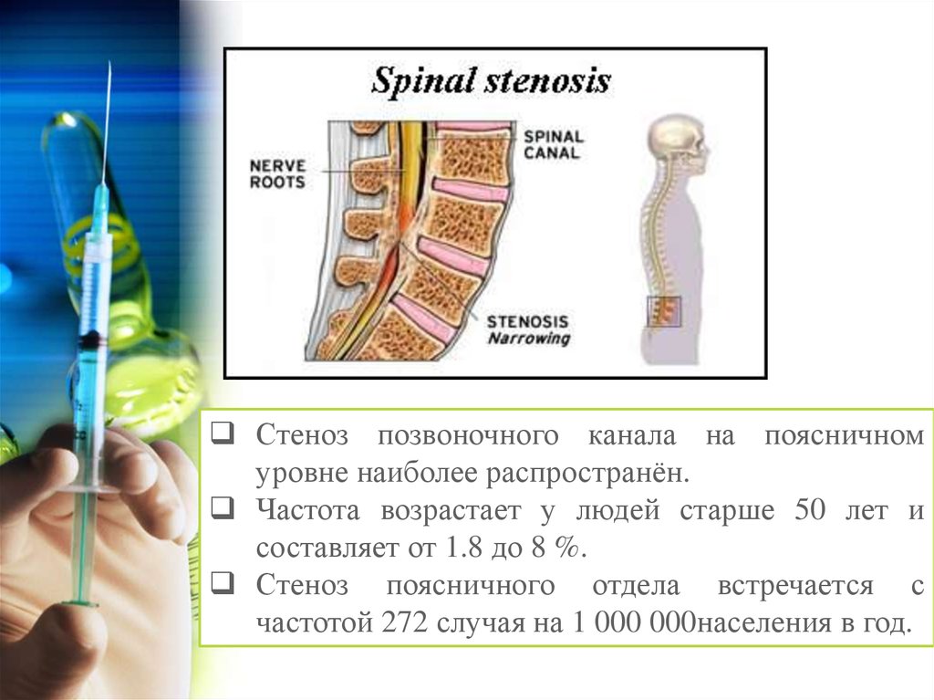 Каналы позвоночника. Сужение спинномозгового канала в поясничном отделе. Сужение межпозвонковых отверстий поясничного отдела. Грыжа позвоночника поясничного отдела со стенозом. Сужение корешковых каналов поясничного отдела позвоночника.