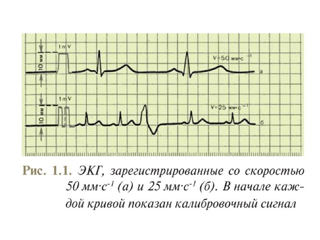 Мм экг. Нормальная ЭКГ 50 мм/с. Калибровочный сигнал ЭКГ 25 мм/с. Электрокардиограмма скорость 25 мм и 50мм. ЭКГ скорость 50 мм/с.