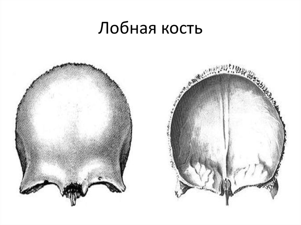 Остеома лобной кости фото