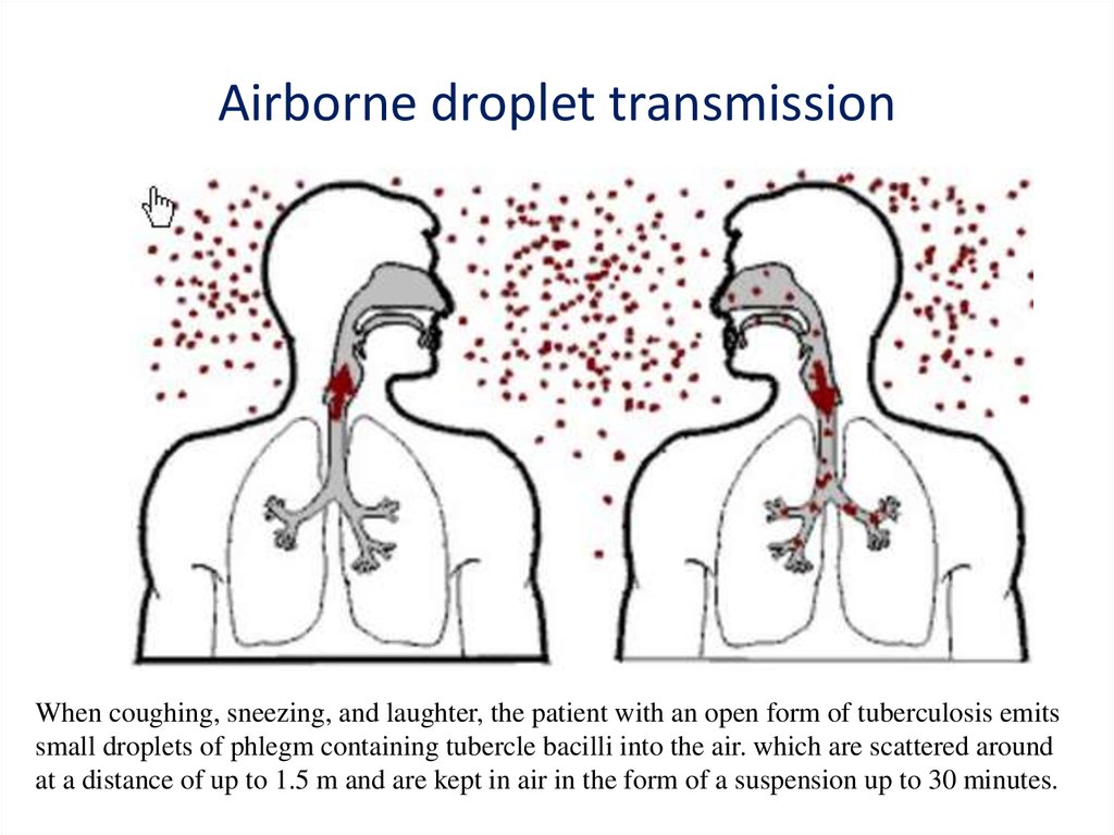 Pulmonary Nuberculosis 