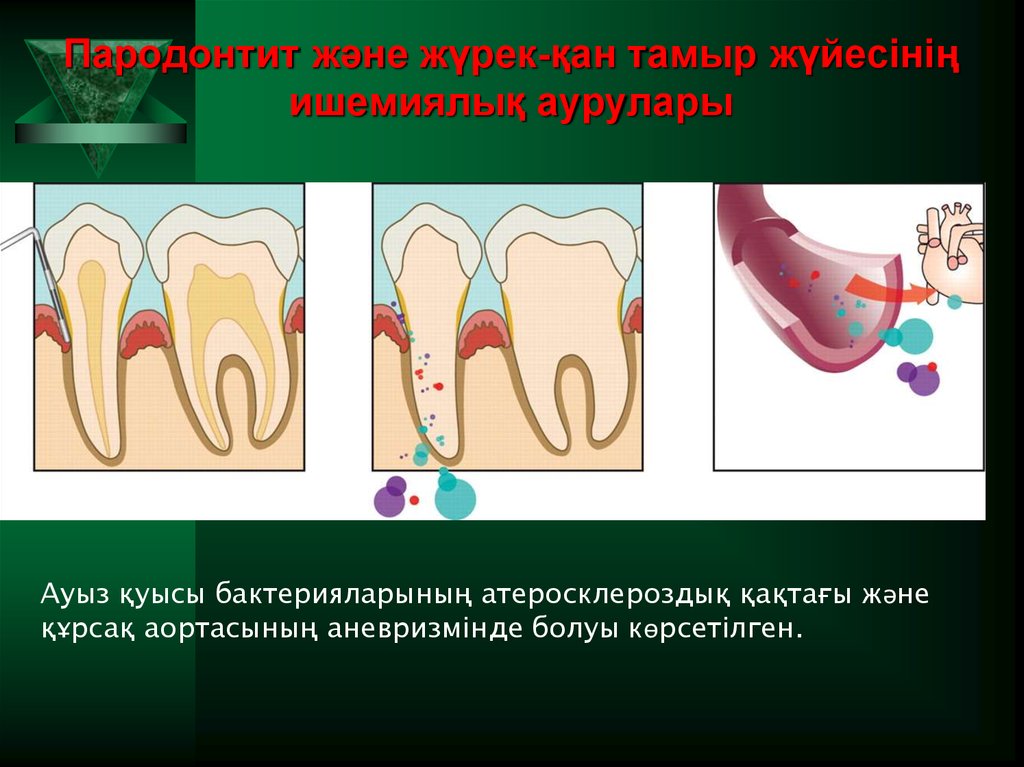 Пародонтит және жүрек-қан тамыр жүйесінің ишемиялық аурулары
