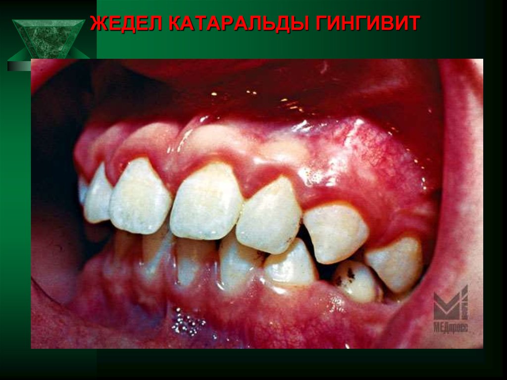 ЖЕДЕЛ КАТАРАЛЬДЫ ГИНГИВИТ