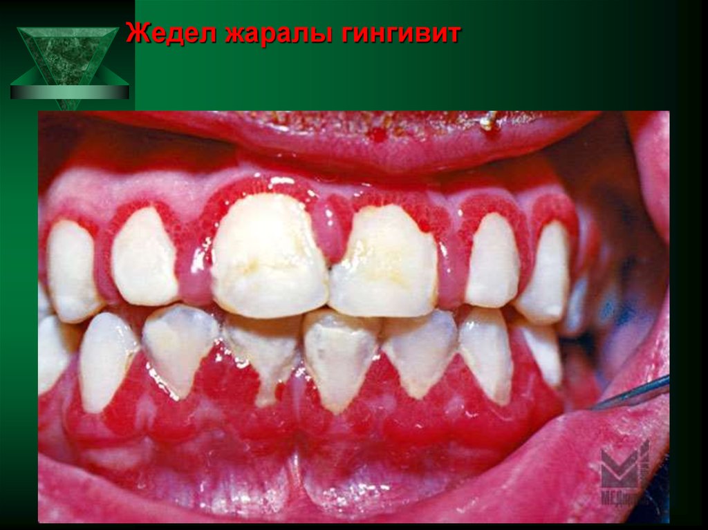 Жедел жаралы гингивит