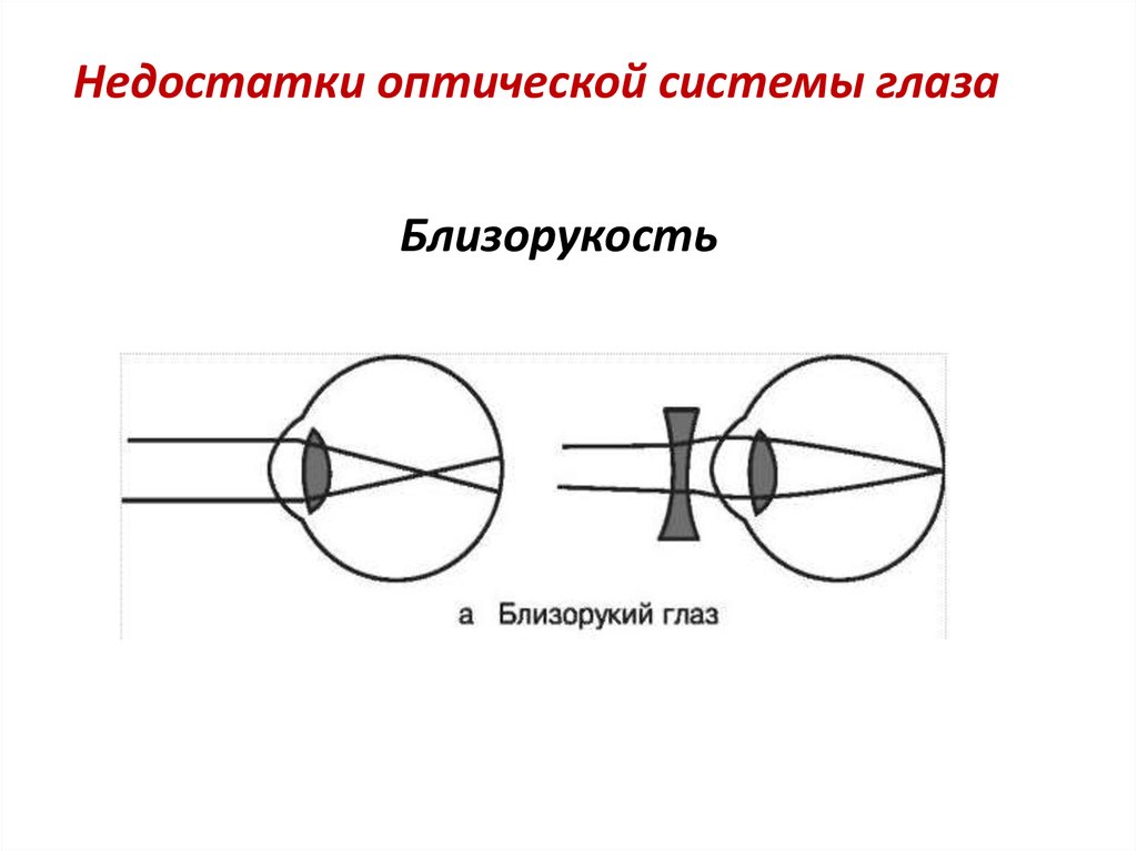 Расположение f оптической системы глаза схема близорукости