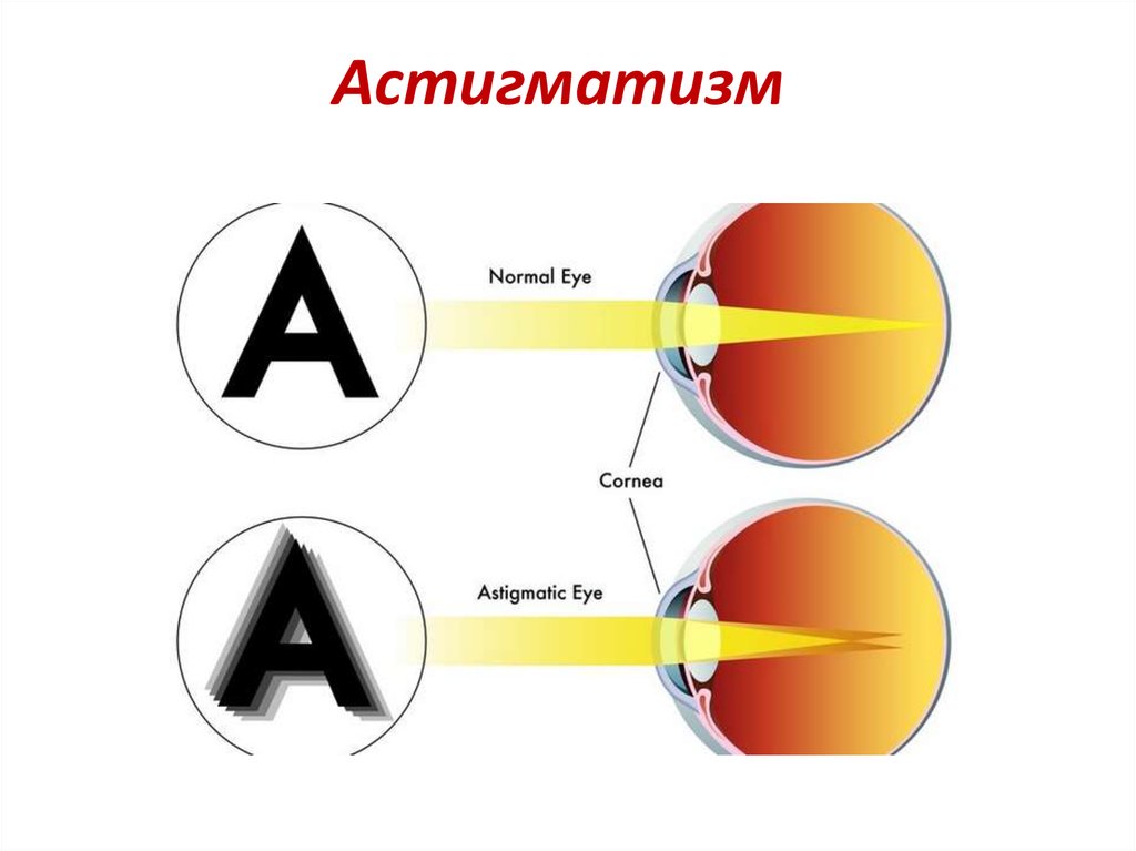 Астигматизм.