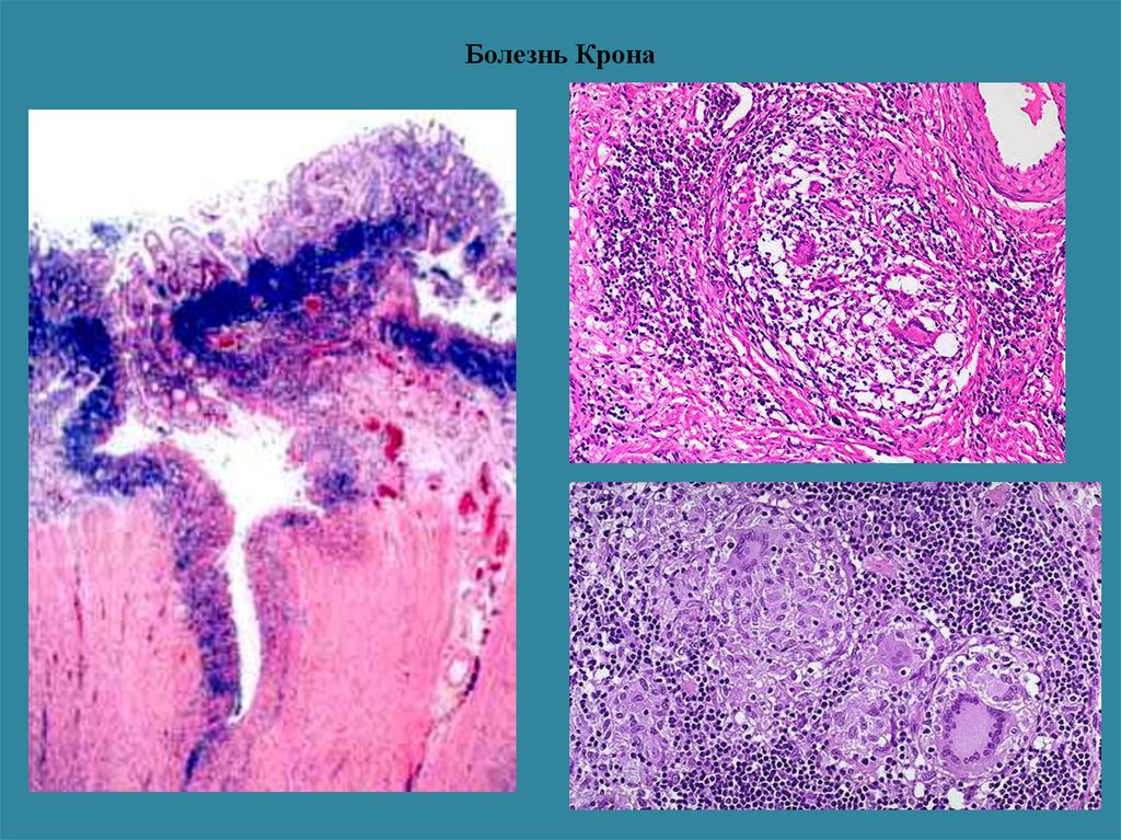 Крон ауруы презентация - 98 фото
