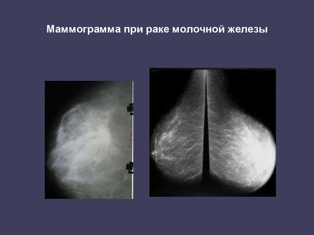 Онкология молочных желез симптомы. Опухоль молочной железы маммограмма. Онкология на маммографии. Маммография опухоль молочной железы. Рик молочной железы маммографич.
