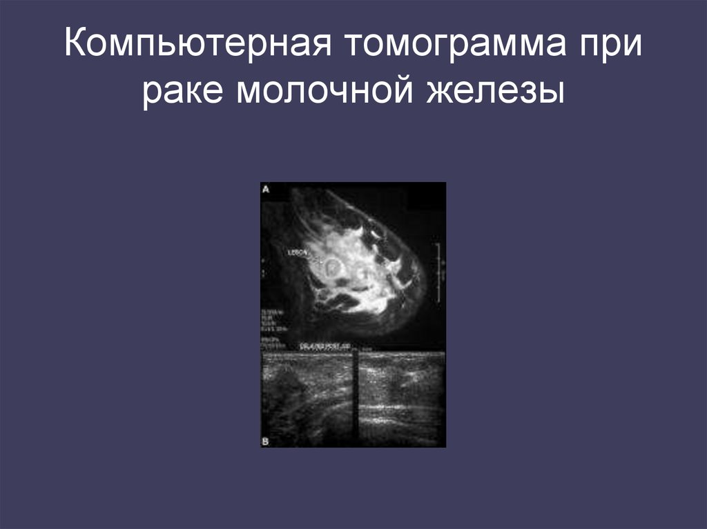 Компьютерная томограмма при раке молочной железы