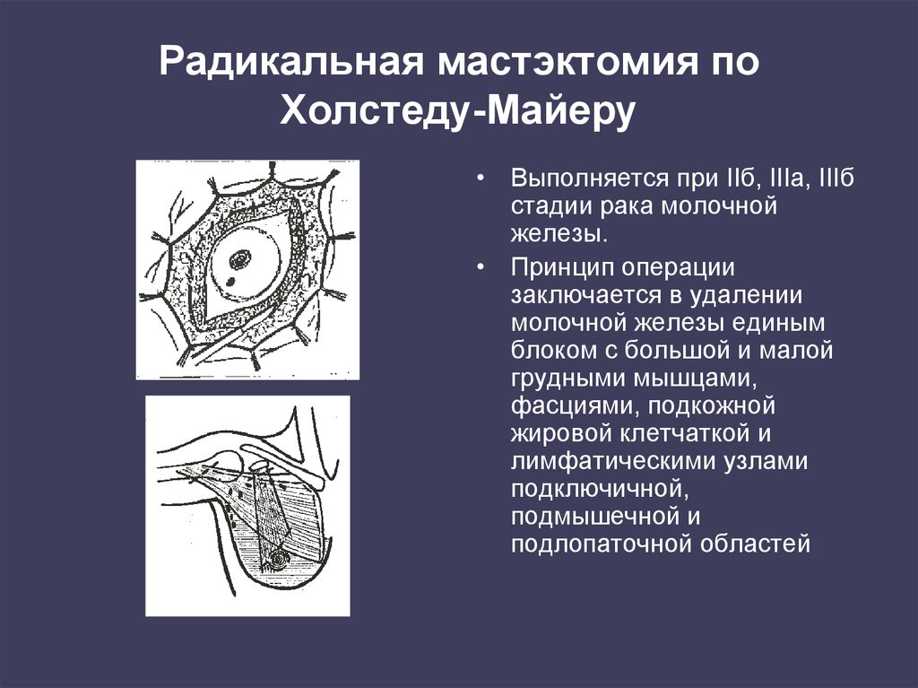 Техника мастэктомии