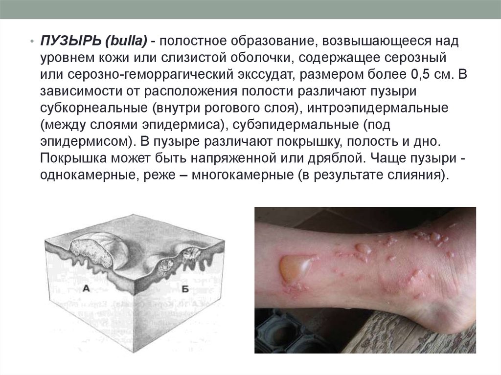 Розацеа. Сосудистые изменения кожи. Как лечить?