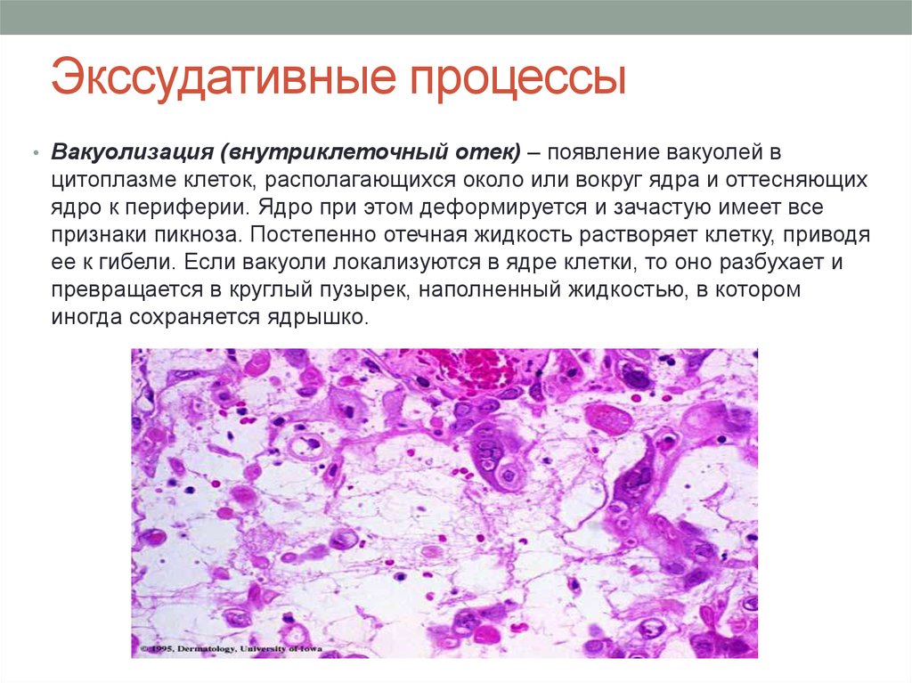 Экссудация это в патологии. Пролиферативное воспаление патанатомия. Экссудативное воспаление патанатомия. Экссудативный процесс. Экссудативный воспалительный процесс.