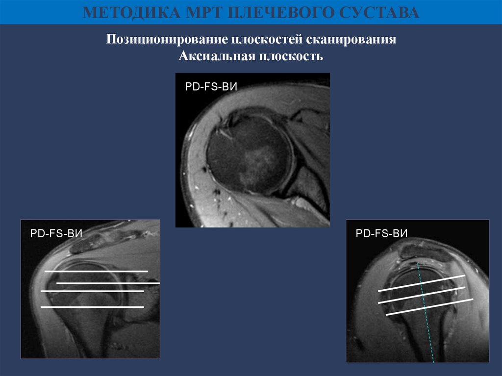 Мрт плечевого. Аксиальная плоскость сканирования мрт. Тендинит плечевого сустава мрт. Аксиальная анатомия плечевого сустава мрт. Плечевой сустав на мрт позиционирование.