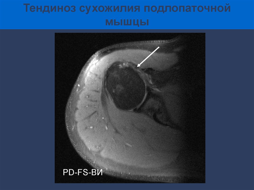 Тендиноз сухожилия что это. Тендиноз сухожилия надостной мышцы мрт. Тендиноз надостной мышцы плечевого сустава мрт. Тендиноз сухожилия подлопаточной мышцы.