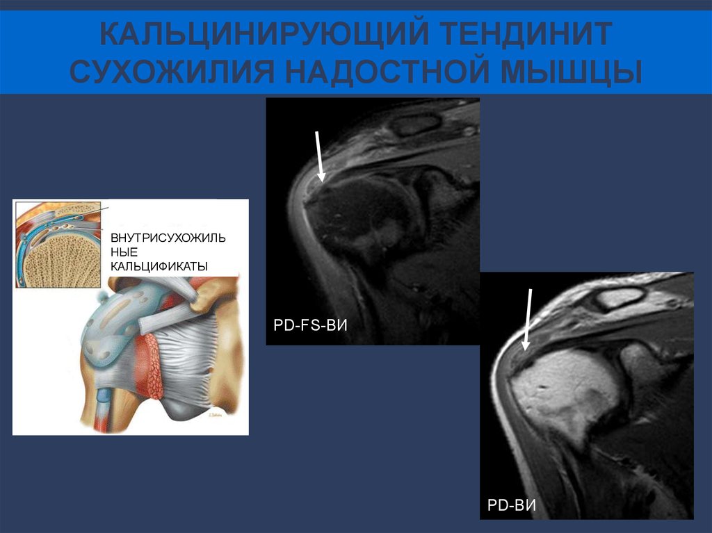 Разрыв надостного сухожилия плечевого сустава лечение. Тендинит сухожилия надостной мышцы мрт. Надостная мышца плечевого сустава мрт. Кальцинирующий тендинит плечевого сустава мрт. Тендинопатия сухожилия надостной мышцы плечевого сустава.